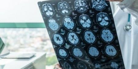 اجراءات طبية سريعة يجب اعتمادها عند حدوث الجلطة الدماغية
