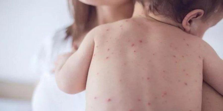 انتهاء حالات تفشي الحصبة في ولايتي "ميشيجان" و"بنسلفانيا" الأمريكيتين