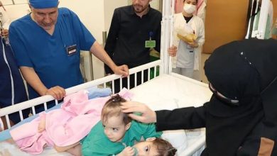 بدء عملية فصل التوأم السيامي السوري "سيلين وإيلين"