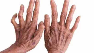 توفير علاج الجذام مجانا على مدار 24 ساعة في عيادات الجلدية بجميع المحافظات