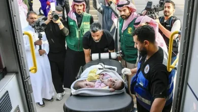 فصل التوأم السوري الملتصق سيلين وإيلين يبدأ رسميًا في مستشفى بالرياض