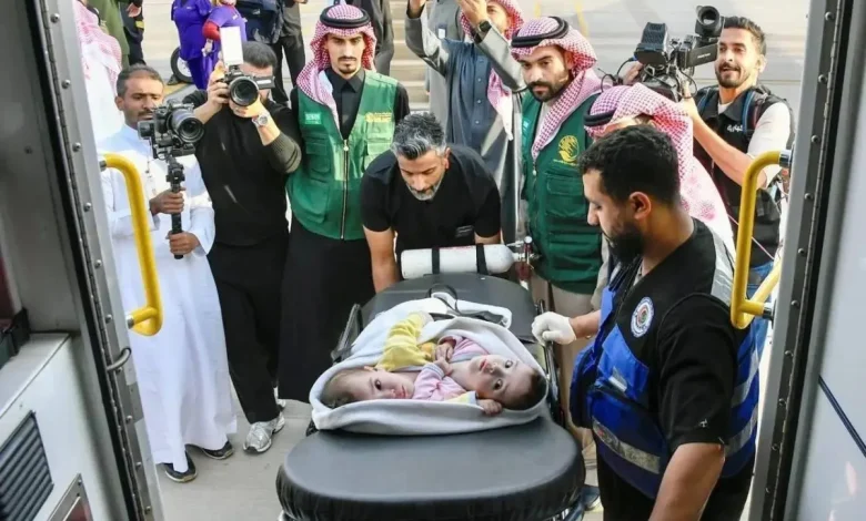 فصل التوأم السوري الملتصق سيلين وإيلين يبدأ رسميًا في مستشفى بالرياض